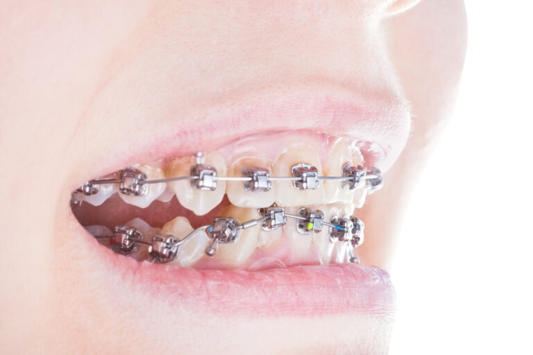 Selfligating braces Taramides